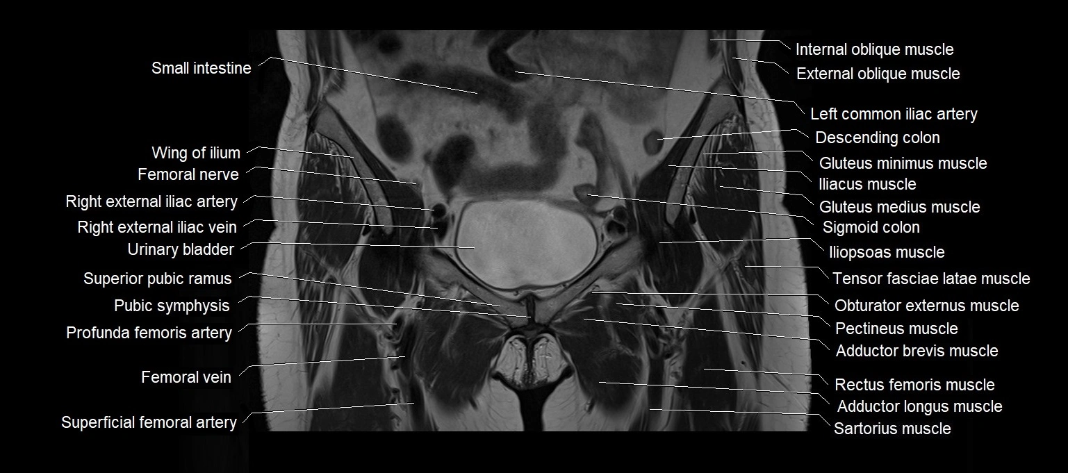 MRI 3T pelvis coronal cross section anatomy image 8.webp